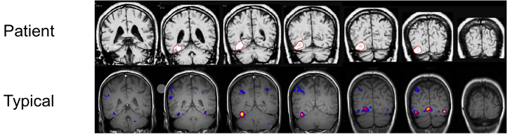 <p>prosopagnosia: aka ‘face blindness’ though there is nothing wrong with vision, inability to recognize faces (specifically faces, not other objects)</p><p>(a)<span style="font-family: Times New Roman">&nbsp;&nbsp; </span>ex: can’t tell one person apart from another person</p><p>(b)<span style="font-family: Times New Roman">&nbsp; </span>could be development or acquired (from strokes or tumor)</p><p>shows that face-processing a domain-specific system since patients with prosopagnosia didn’t show similar activation in FFA as typical individuals, which meant that brain region had been affected</p><ul><li><p><span style="font-family: Calibri, sans-serif">Could be FFA that’s affected</span></p></li><li><p><span style="font-family: Calibri, sans-serif">Could be hurting holistic processing</span></p></li><li><p><span style="font-family: Calibri, sans-serif">Doesn’t impact emotion recognition, implying separate processing&nbsp;</span></p></li></ul>