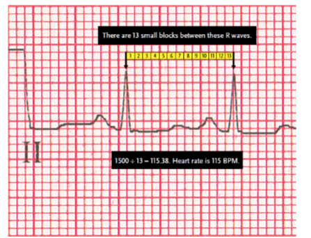 <p>method used to determine heart rate from an EKG tracing that involves counting the small blocks between two consecutive R waves and dividing that number into 1500, which is the number of small blocks representing the passage of one minute; also called the 1500 method.</p><p></p>
