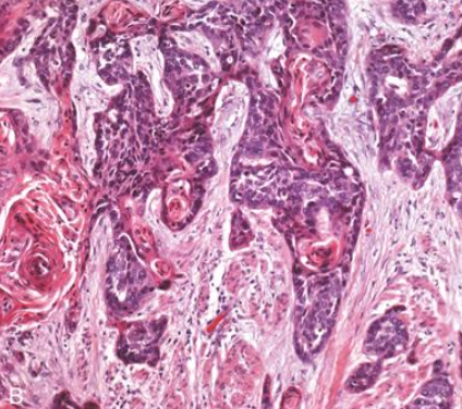 <p>Carcinoma de células escamosas, nivel de diferenciación</p>