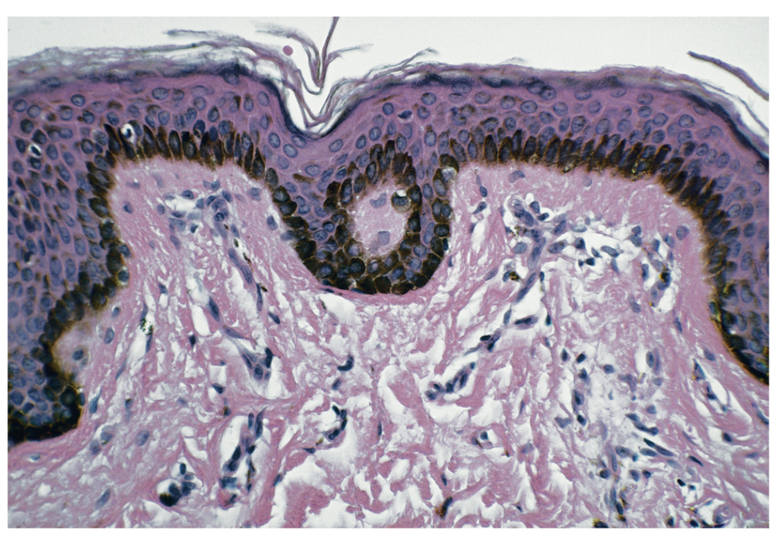 <p>Stratified squamous epithelium (keratinized).</p>