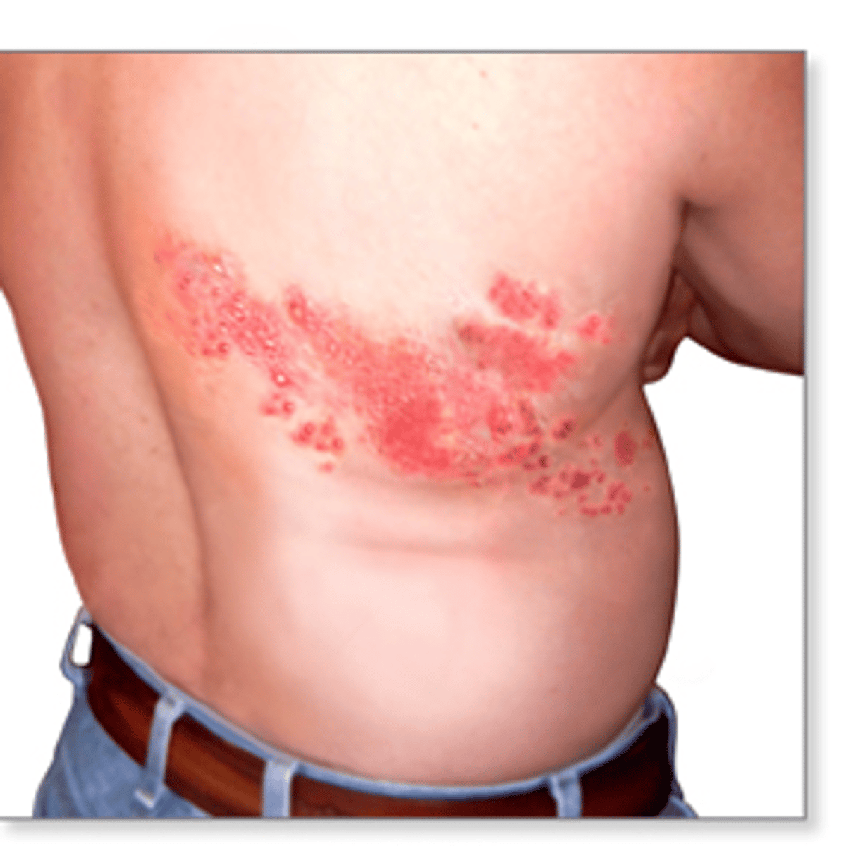 <p>Tingling/burning/stinging → one sided vesicular rash on neck or chest, pain can persist for months-years after rash clears (post herpetic neuralgia)</p>