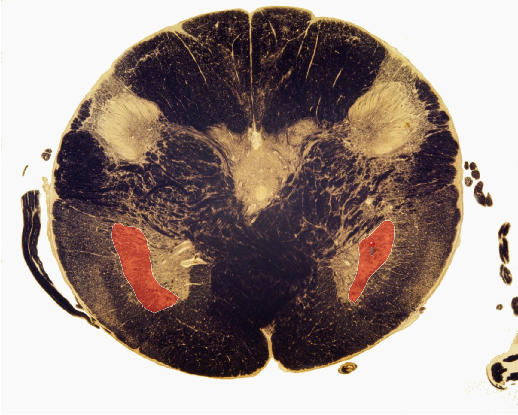 <p>Accessory Nucleus </p><p></p><p>Motor Neurons for Trapesius &amp; SCM</p>