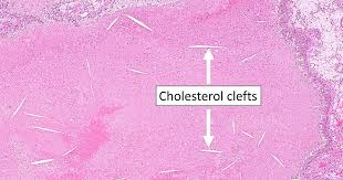<p>What are Cholesterol Clefts/Crystals?</p>