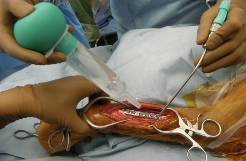 <p><span>Strict aseptic technique should be practiced. First, the hair is clipped and sterile water soluble jelly is applied to protect the wound. Sterilely prepare the limb for surgery with copious lavage, debridement, and sterile bandaging.</span></p>