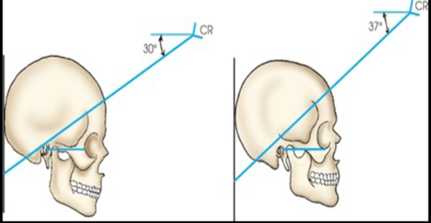 <p>Which projection uses these angulations?</p>