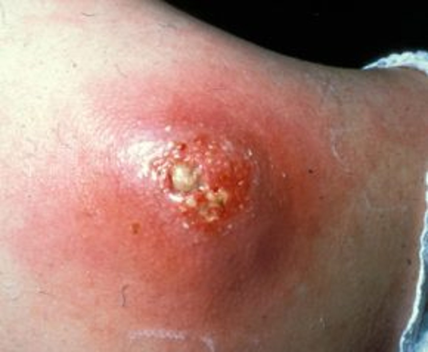 <p>= acuut etterende diepe necrotiserende ontsteking van een haarfollikel</p><ul><li><p>erythemateuze nodulus</p></li><li><p>centrale necrose / pustel</p></li></ul><p>verwekker : stafylococcus aureus </p><p>R/ </p><ul><li><p>pus draineren </p></li><li><p>systematische antibiotica : bij systeemsymptomen of optreden rond neus of bovenlip </p></li></ul><p></p>