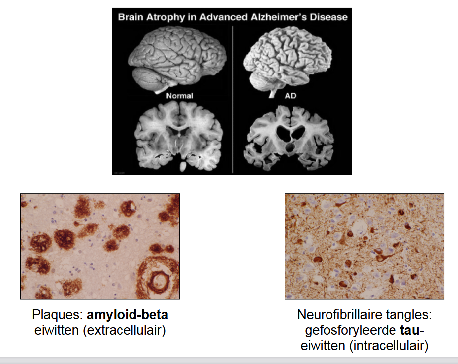 <ul><li><p>neerslag van 2 eiwitten</p><ul><li><p>amyloid-beta eiwitten (extracellulair) → plaques</p></li><li><p>gefosforyleerde tau-eiwitten (intracellulair) → neurofibrillaire tangles</p></li></ul></li></ul><p></p>