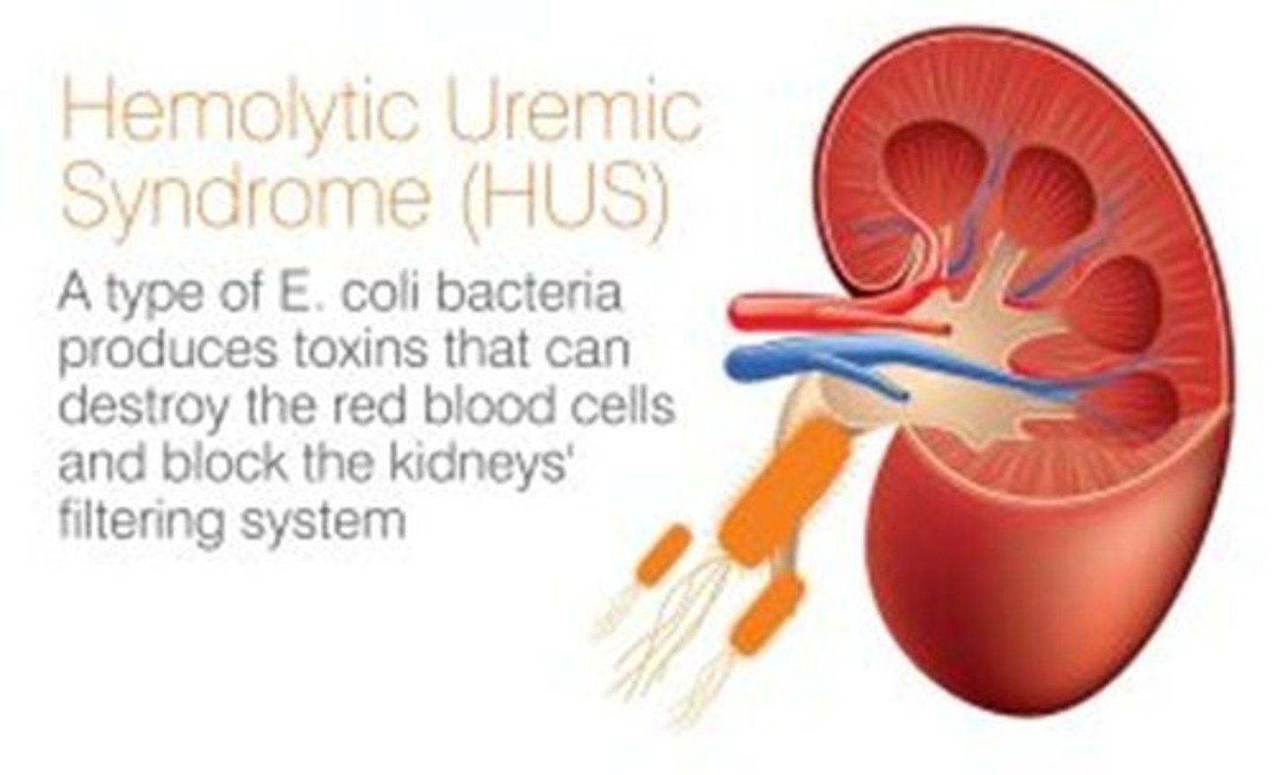<p>Infection with Shiga toxin-producing Escherichia coli (STEC), often preceded by gastroenteritis.</p>