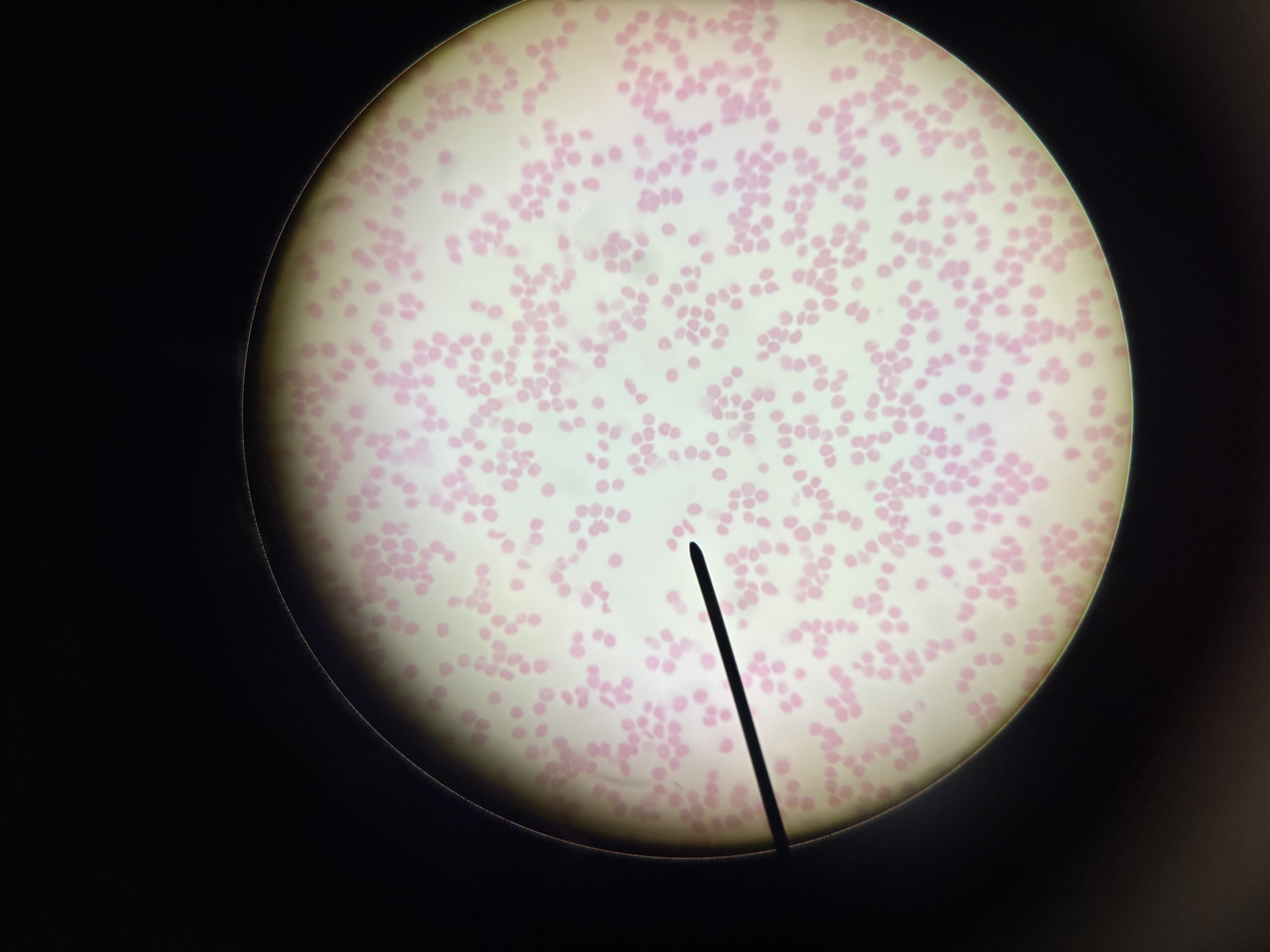 <p>sickle cell anemia</p>