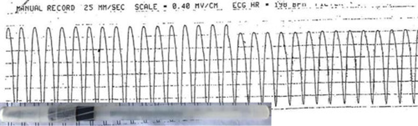 <p>What arrhythmia is this?</p>