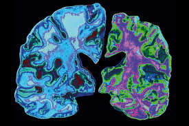 <p><strong>A geriatrician and social worker are facilitating a family meeting for the children and wife of a 79-year-old man who has been diagnosed with Alzheimer disease. What goal of treatment will the clinicians most likely prioritize in their interactions with the family?</strong></p><p>A) Modest reversal of brain plaque formation and improved symptomatology through cholinesterase inhibitors</p><p>B) Surgical treatment of the underlying ischemic changes that underlie the manifestations of the man's disease</p><p>C) The use of medications such as donepezil and rivastigmine to slow the progression of the disease</p><p>D) Cognitive and behavioral therapy to counteract the agitation, depression, and suspiciousness associated with Alzheimer disease</p>