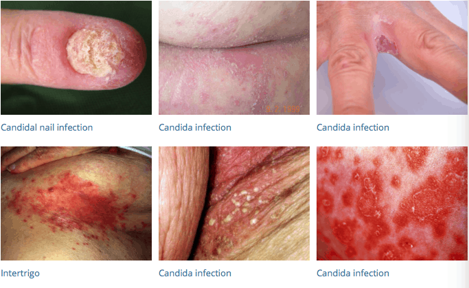 <p>Discuss skin with Candida, also are bacterial infections less or more common?</p>
