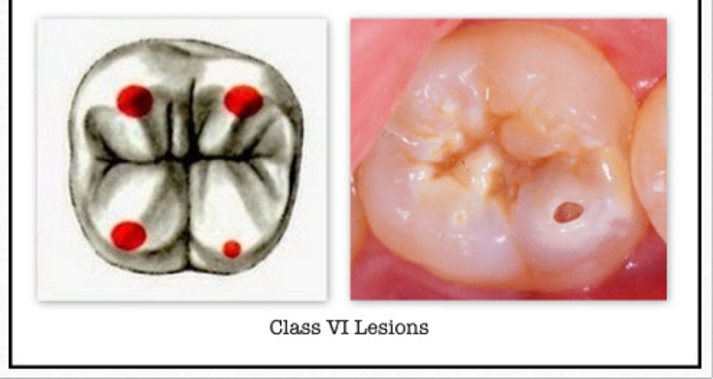 <p>GV Black Classification of Caries:</p><p>- Incisal edges of anterior teeth </p><p>- or occlusal cusp tips of posterior teeth</p><p>- ONLY cusp tips </p>