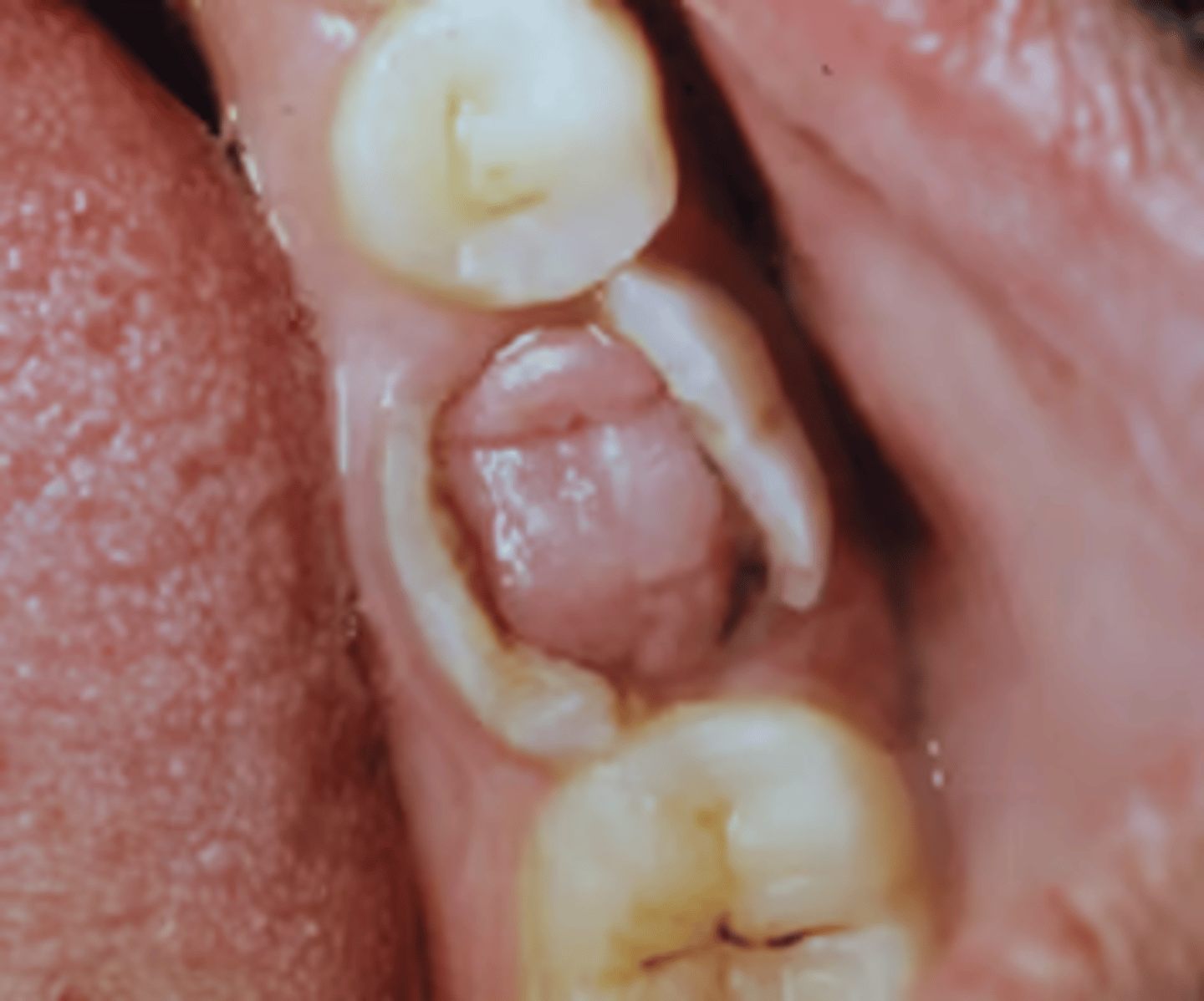 <p>Excessive proliferation of chronically inflamed dental pulp tissue; Occurs in teeth with large, open carious lesions often in primary & permanent molars; Usually asymptomatic</p>