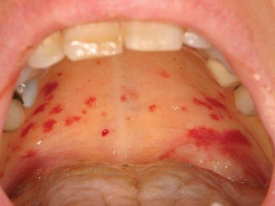 <ul><li><p><span>small red-purple haemorrhages on the oral mucosa, often seen on the palate</span></p></li><li><p><span>sign of infective endocarditis</span></p></li></ul><p></p>