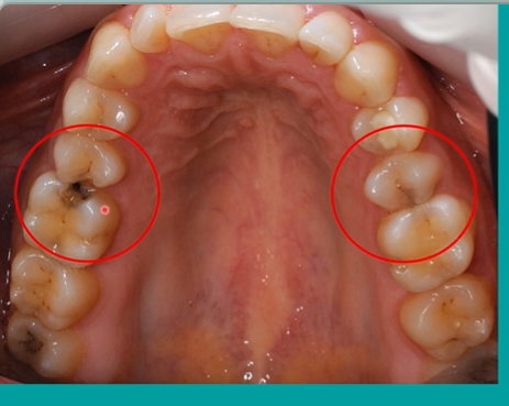 <p>compare the distal aspect of the upper 5s and the mesial aspects of the upper 6s - what can you see?</p>