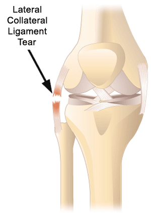 <p>most lateral ligament of the side of knee</p>