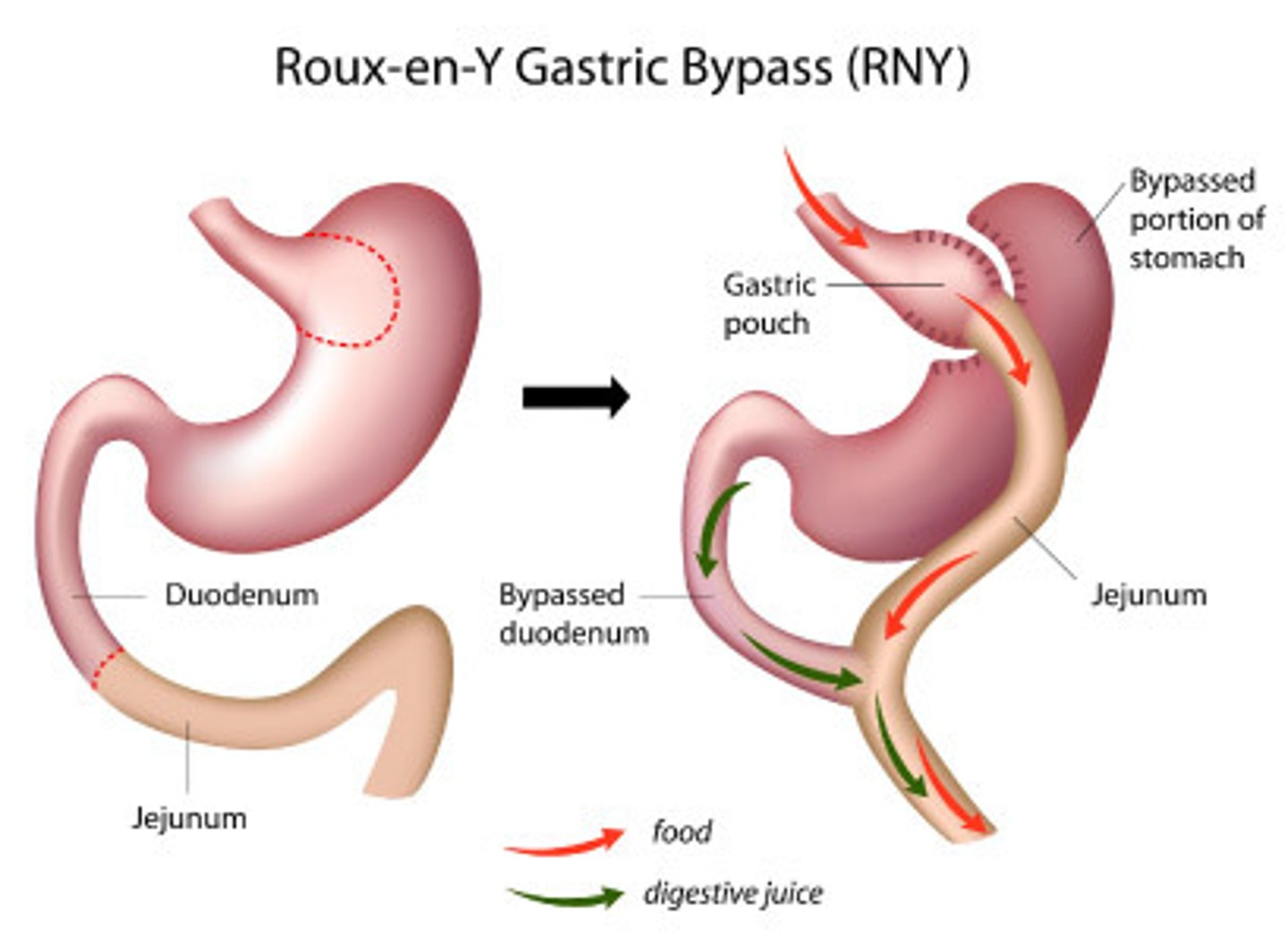 <p>- Mechanism = restriction and malabsorption</p><p>- Irreversible</p><p>- More invasive</p><p>- Comparable efficacy to SG</p><p>- More major complications</p>