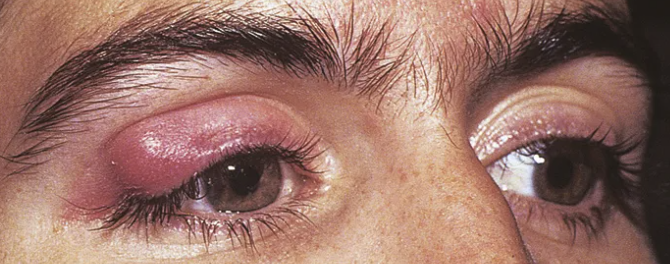 <p>Abnormal Findings for <strong><em>5. Redness, swelling, discharge, or lesions</em></strong></p><ul><li><p>Infection of the <strong>meibomian gland</strong> (located in the eyelid)</p></li><li><p>May produce extreme swelling of the lid, moderate redness, but minimal pain</p></li></ul><p></p>