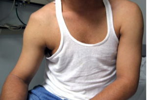 <p><strong>Anterior Shoulder Dislocation</strong></p><p>-Most common dislocation</p><p>-Mechanism of Injury:</p><ul><li><p>Blow to _________, externally rotated, and extended arm</p></li><li><p>Blow to __________ humerus or fall on outstretched arm (less common)</p></li></ul><p>-S/S:</p><ul><li><p>__________ and externally rotated arm (elbow pointing out)</p></li><li><p>_______ all movement </p></li><li><p>Prominent acromion → “squared off” shoulder (positive Sulcus sign)</p></li><li><p>Evaluate _______ nerve and vasculature </p></li></ul><p></p>