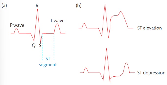 <p>• ST elevation- complete blockage of coronary artery, severe</p><p>• ST depression- partial blockage</p>