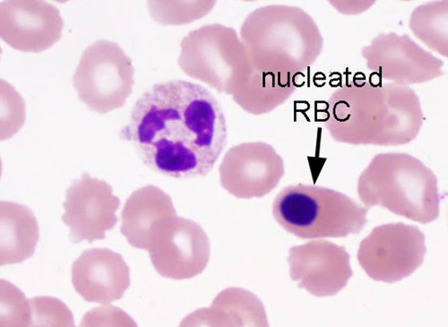 <p>Immature cells released into circulation before enucleation; bone marrow issues</p>