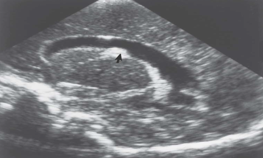 <p>What pathology is shown in this image?</p>