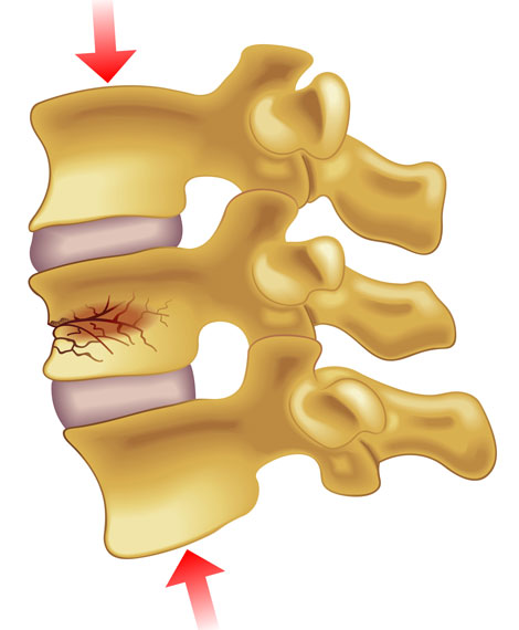 <p>Vertebrae of spine collapses</p><ul><li><p>COMMON IN OLD WOMEN</p></li><li><p>Cause: Osteoporosis</p></li></ul><p></p>