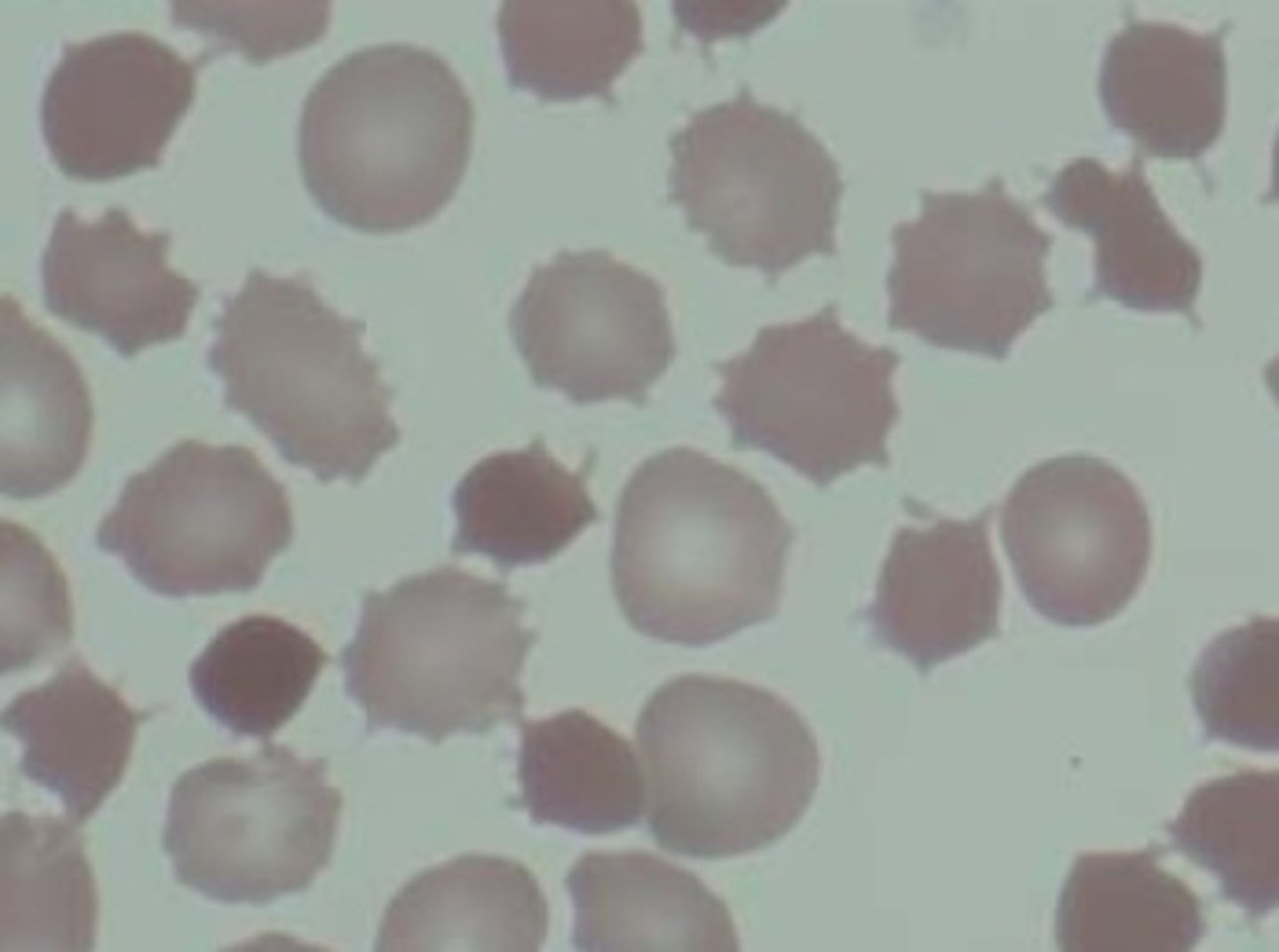 <p>Abetalipoproteinemia (when you can’t absorb fats)</p>