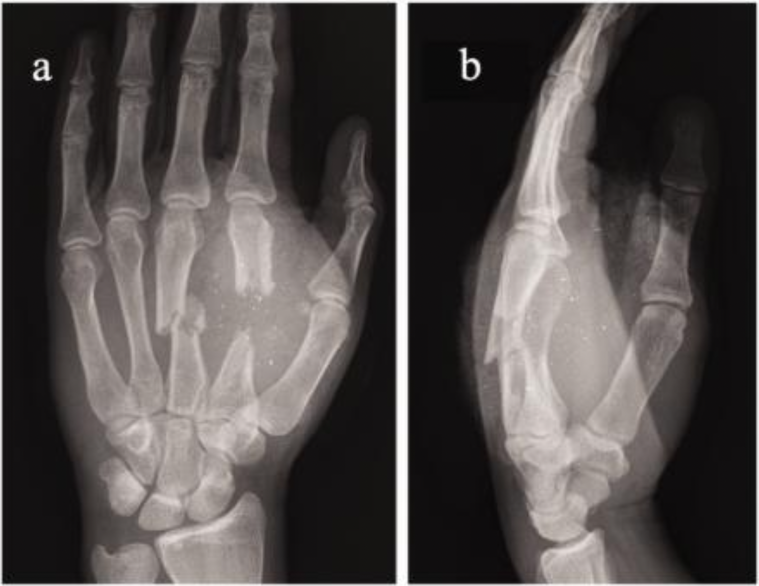 <p>Quel est l’impact d’une consolidation en mal position d’une fracture d’un métacarpe?</p><p>E<span>n bascule palmaire : </span></p><p><span>En bascule dorsale : </span></p><p><span>En rotation « vers la supination » :</span></p>