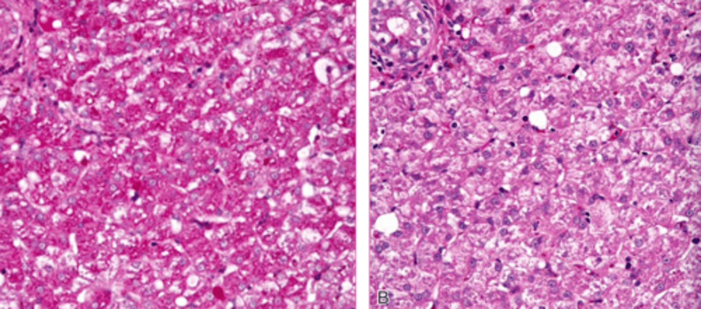 <p>Both of these images are PAS stains to see glycogen... what's different about them?</p>