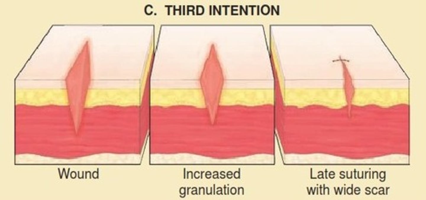 <p>This is a combination of primary and secondary closure. The wound is initially left open to be cleansed and observed for signs of infection or contamination (common in traumatic injuries or if the wound has been untreated for more than 4 hours). Once the wound bed appears clean and free of debris, it is surgically closed. Ex. SKIN GRAFT</p>