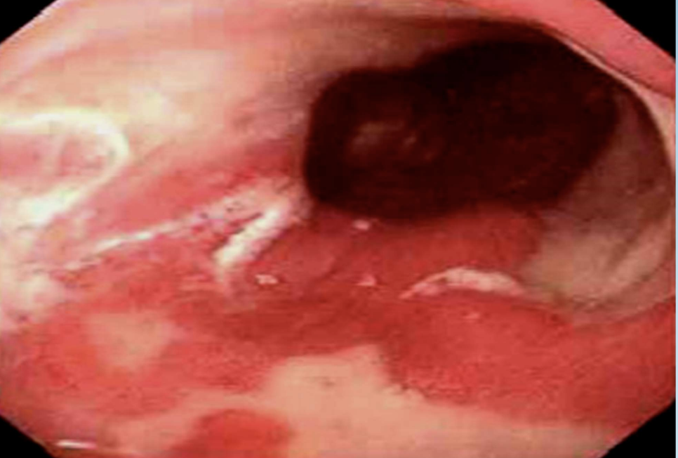 <p>Barrett Esophagus</p>