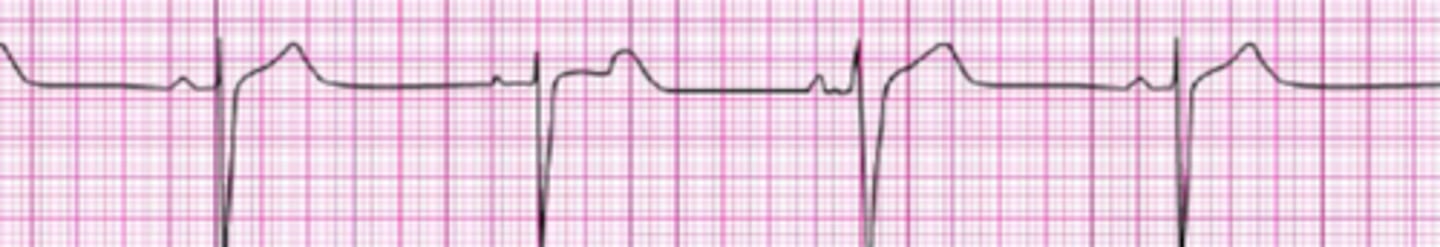 <p>Sinus Bradycardia</p>