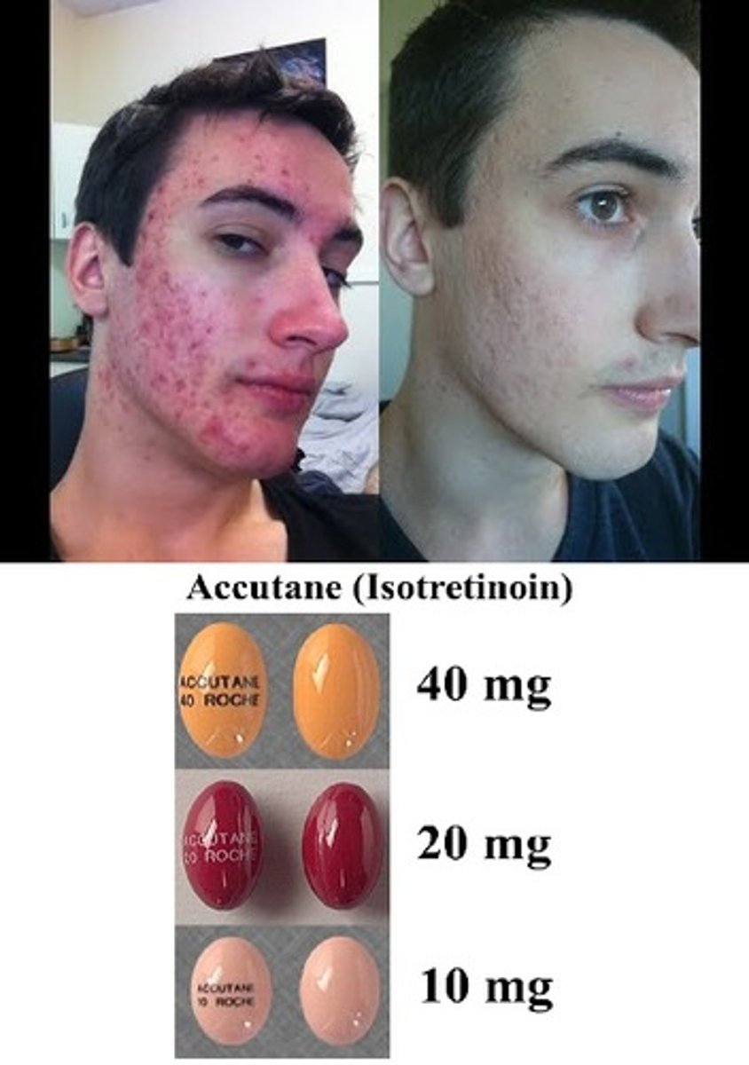 <p>It shuts down the sebaceous glands,</p><p>It stops mitosis*</p><p>Accutane is a teratogenic</p>