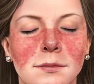 <p><span style="color: blue;"><strong><em><u>AUTOIMMUNE</u></em></strong></span></p><p>Lupus Erythematosus</p><ul><li><p>Clinical Signs</p></li><li><p>Etiology</p></li><li><p>Treatment</p></li></ul><p></p>