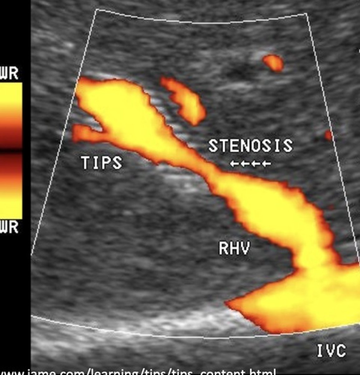 <p>< 50 cm/sec velocity within stent</p><p>Focal area velocity increase > 200 cm/sec</p><p>> 50 cm/sec velocity change in same portion of stent compared to past exams</p>