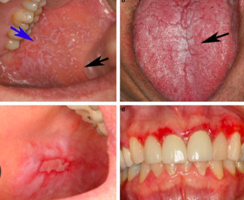 <p><span>an oral mucosal condition that is </span><span style="color: red;"><span>clinically and histologically indistinguishable from OLP</span></span><span> except for identifiable causes</span></p><p><span>when the </span><span style="color: red;"><span>cause</span></span><span> (such as amalgam or an offending medication) </span><span style="color: red;"><span>is removed</span></span><span> the</span><span style="color: red;"><span> lesion will resolve with time</span></span></p>