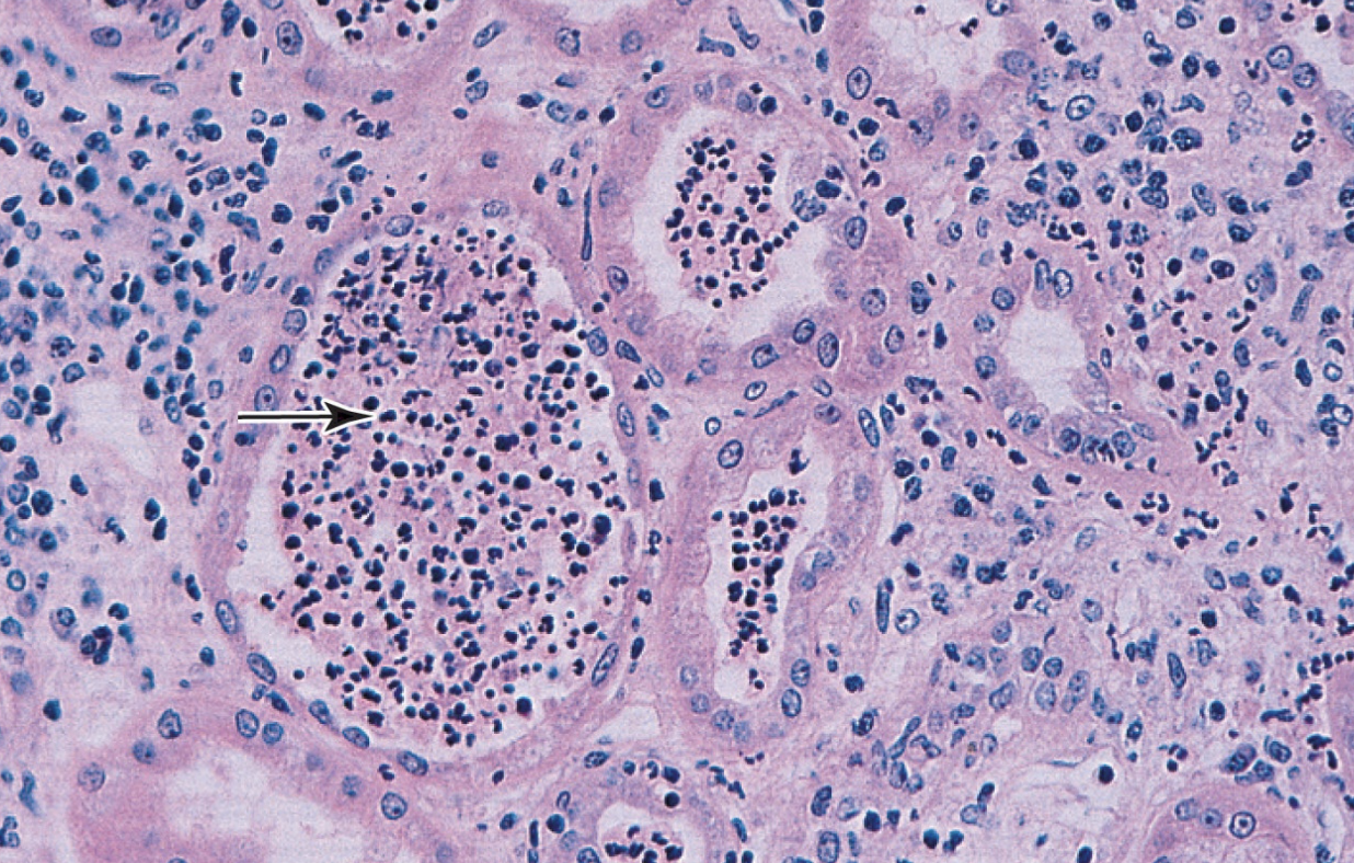 <p>What complication of an acute pyelonephritis is shown at the arrow?</p>