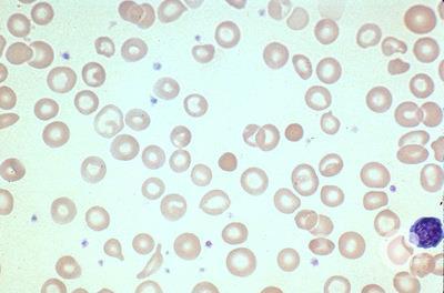 Iron deficiency anemia