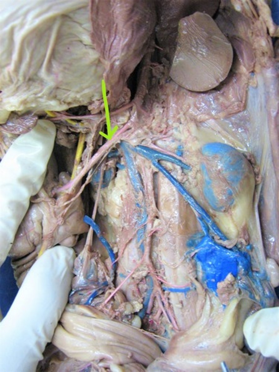 <p>identify this artery</p>