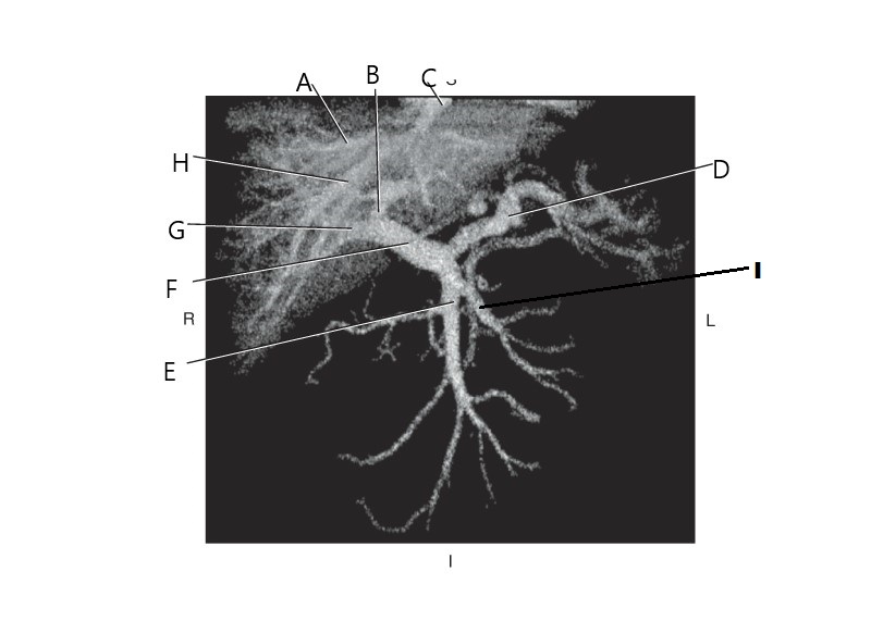 <p>middle hepatic vein</p>