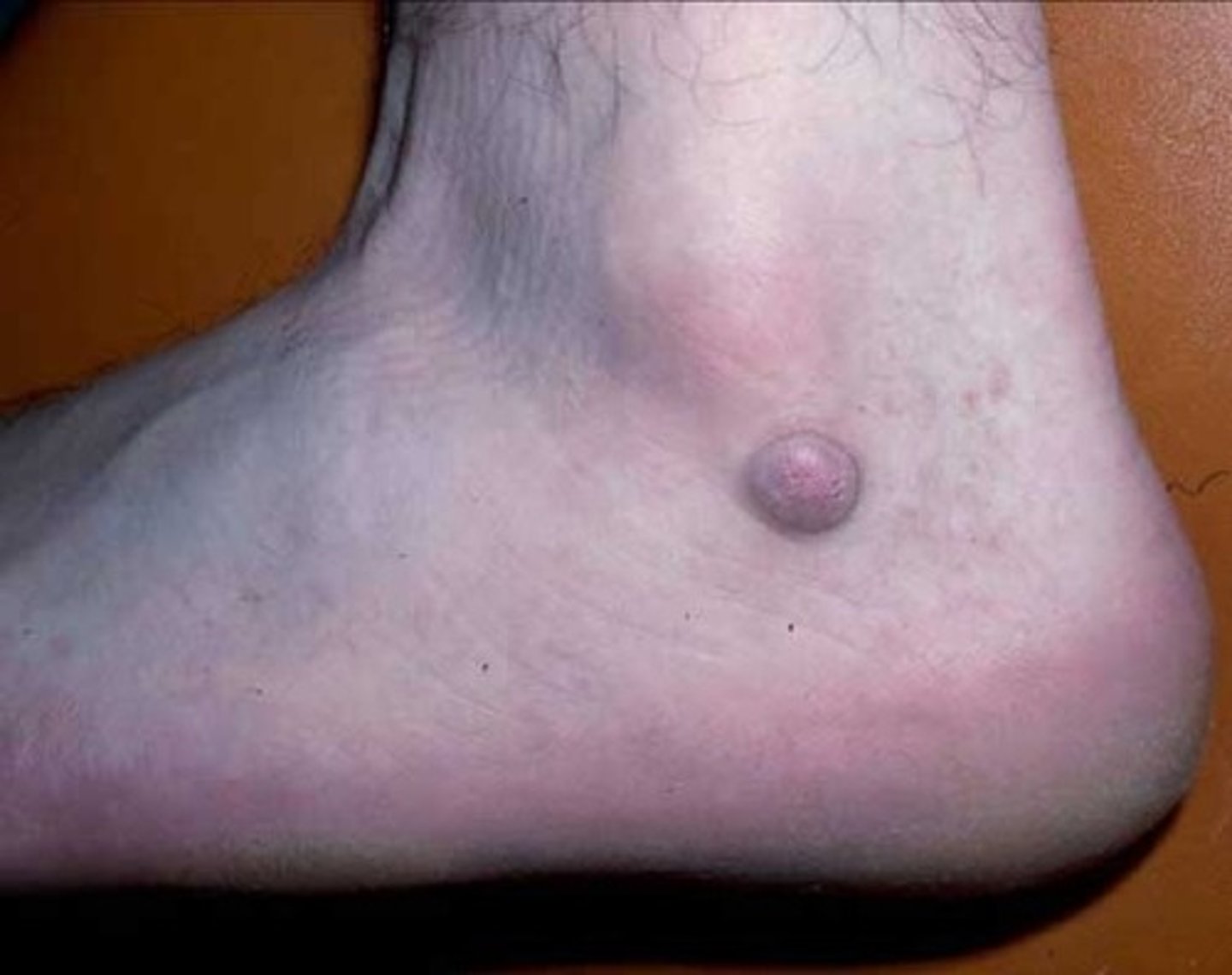 <p>a firm and movable solid elevation, 0.5-1 cm in diameter, which extends deeper into the dermis than a papule.</p>