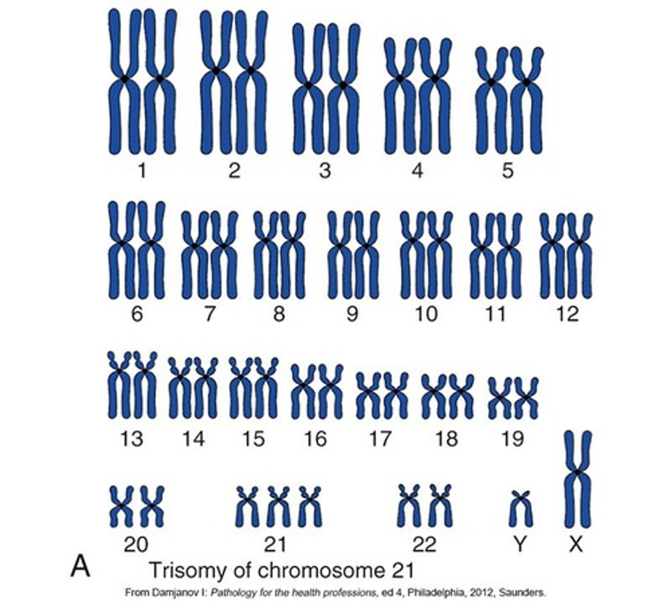 <p>Down syndrome is a form of aneuploidy characterized by three copies of chromosome 21 (trisomy 21).</p>