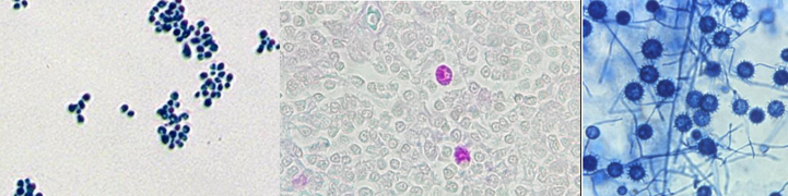 <p><span style="font-family: &quot;Times New Roman&quot;, serif; line-height: 107%;"><span>Clinical association: systemic infection found in macrophages</span></span></p><p class="MsoListParagraphCxSpMiddle"><span style="font-family: &quot;Times New Roman&quot;, serif; line-height: 107%;"><span>Has two forms – mould or yeast (aka thermally dimorphic fungi)</span></span></p><p class="MsoListParagraphCxSpMiddle"><span style="font-family: &quot;Times New Roman&quot;, serif; line-height: 107%;"><span>Mould form (25C): septate hyphae, tuberculate chlamydospores</span></span></p><p class="MsoListParagraphCxSpMiddle"><span style="font-family: &quot;Times New Roman&quot;, serif; line-height: 107%;"><span>Yeast/spherule form (37C): small intracellular yeasts</span></span></p><p class="MsoListParagraphCxSpLast"><span style="font-family: &quot;Times New Roman&quot;, serif; line-height: 107%;"><span>Considered a Risk Group 3 fungal agent</span></span></p><p class="MsoListParagraphCxSpLast"><span style="font-family: &quot;Times New Roman&quot;, serif; line-height: 107%;"><span>What is it?</span></span></p>