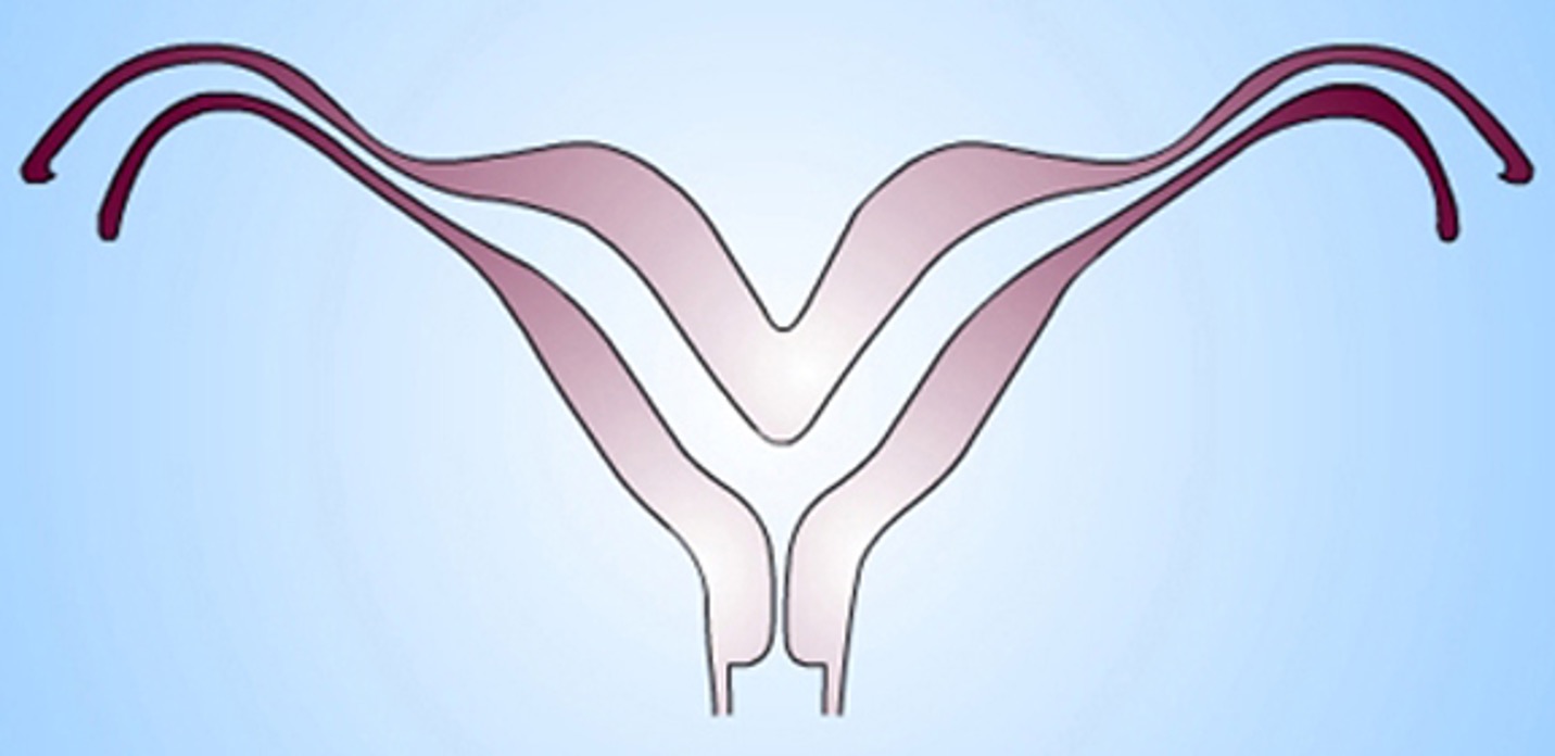 <p>What class mullerian defect?</p><ul><li><p><strong>bicornuate uterus</strong> → results from partial confusion of ducts</p></li><li><p>demonstrates some degree of fusion b/t the 2 horns</p></li><li><p>horns not fully developed, typically smaller</p></li><li><p>some pts are candidates for metroplasty</p></li></ul><p></p>