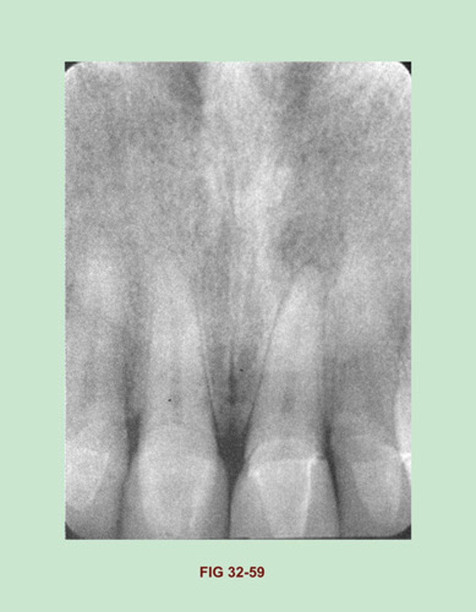 <p>Porcelain crowns</p><p>Side Notes: Porcelain restorations appear radiopaque on a dental image. unlike metallic restorations, which appear completely radiopaque, porcelain restorations are slightly radiopaque & resemble the radio density of dentin. All-porcelain crowns & bridges appear slightly radiopaque on a dental image. A THIN radiopaque line outlining the prepared tooth may be evident through the slightly radiopaque porcelain crown.</p><p>This THIN LINE represents cement or other dental ADHESIVE material used to adhere the crown to the tooth. the RADIODENSITY of an all-porcelain bridge appears identical to that of the all-porcelain crown.</p>