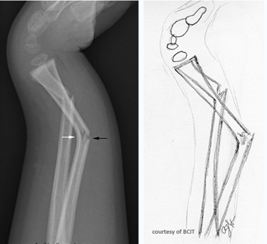 <p>what fracture type is this</p>