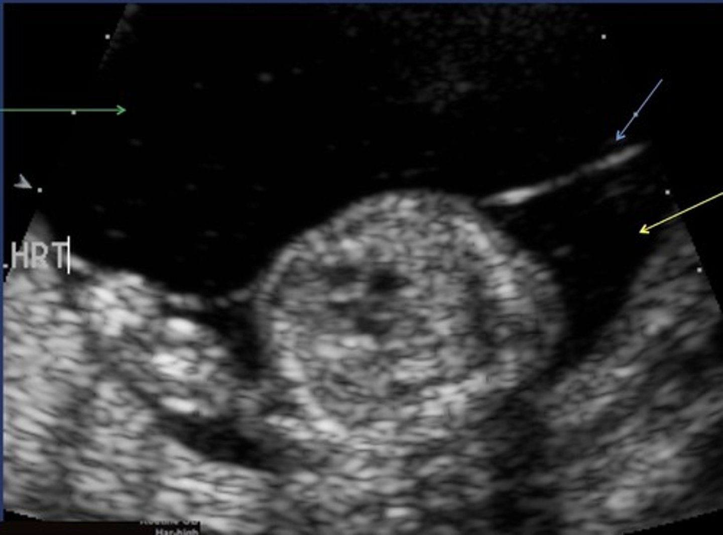 <p>Amniotic fluid discrepancy</p>