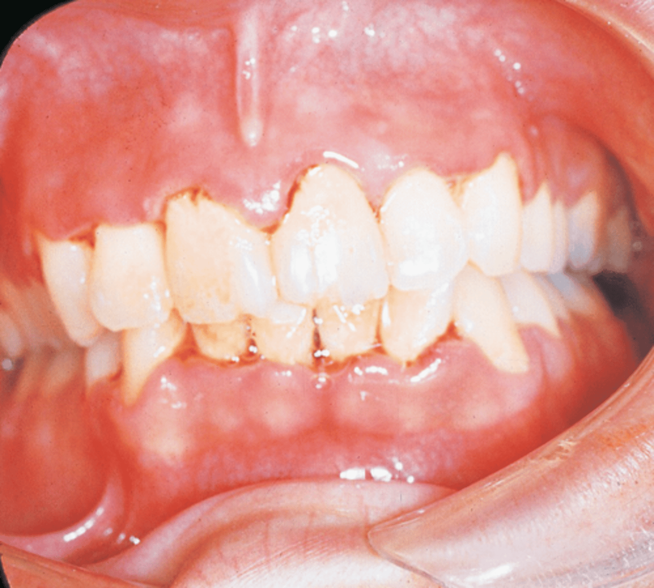 <p>The gingivae shown are painful and erythematous. The interdental papillae appear as punched-out, necrotic, cratering areas. The overall sloughing of the necrotic tissue appears as a pseudomembrane over the tissues. The patient experiences a foul odor and metallic taste. On the basis of these features, which condition is suspected?</p><p>Fusiform bacillus and Spirochete cause this, cratered papilla, and white tissue because of cell death</p>